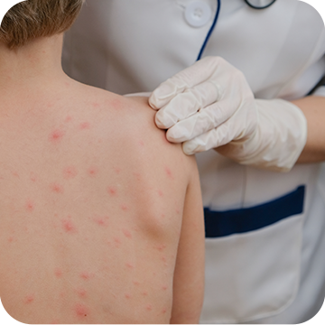 Chicken Pox: Signs, Symptoms, Management, and Treatment