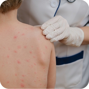 Chicken Pox: Signs, Symptoms, Management, and Treatment – Baby Bum Shower